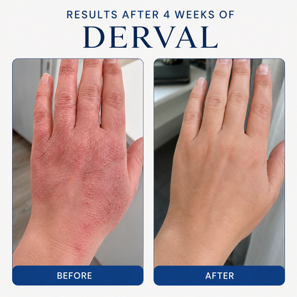 Psoriasis & Eczema Relief Cream