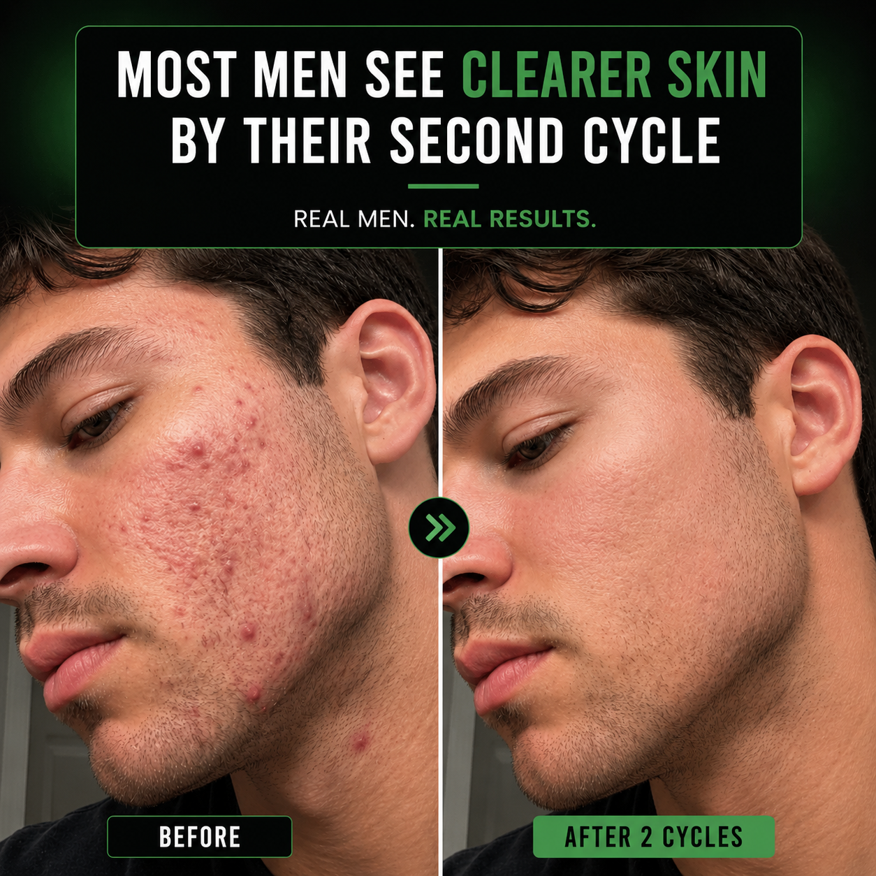 DHT Acne Formula for Men