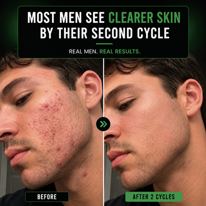 DHT Acne Formula for Men